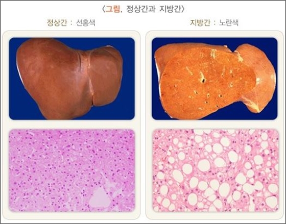 최근 성균관대학교 연구팀은 지방간을 예방하기 위해 술을 줄이고 체중조절과 식습관 개선을 위해 노력해야 한다고 조언했다. ⓒ보건복지부