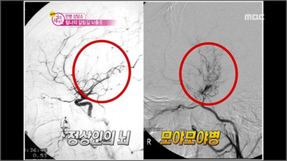 김승기·이지연 공동연구팀은 23일 '모야모야병'의 새로운 원인 유전자를 밝혀냈다.ⓒMBC 시사교양 프로그램 '생방송 금요와이드' 방송 캡처