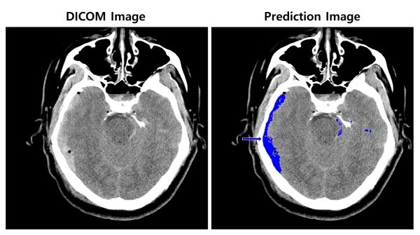뇌출혈 영상 판독 AI 모델 이미지 ⓒSK㈜ C&C