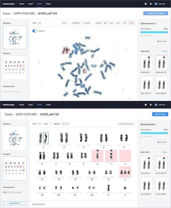 염색체 정렬 및 판독 AI 솔루션 데모 화면.ⓒGC녹십자의료재단